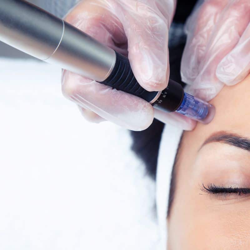 Morpheus8 treatment Godalming from Lipo Sculpt - Book in today!